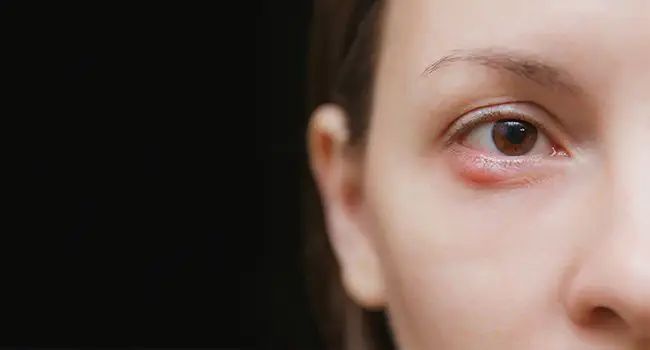 Chalazion