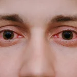 Red Eyes After Swimming