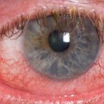 EyePL technology graphic promoting advanced treatments for vision correction