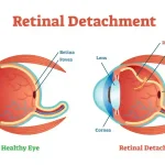 Retinal Detachment