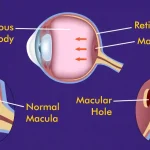 Macular Hole