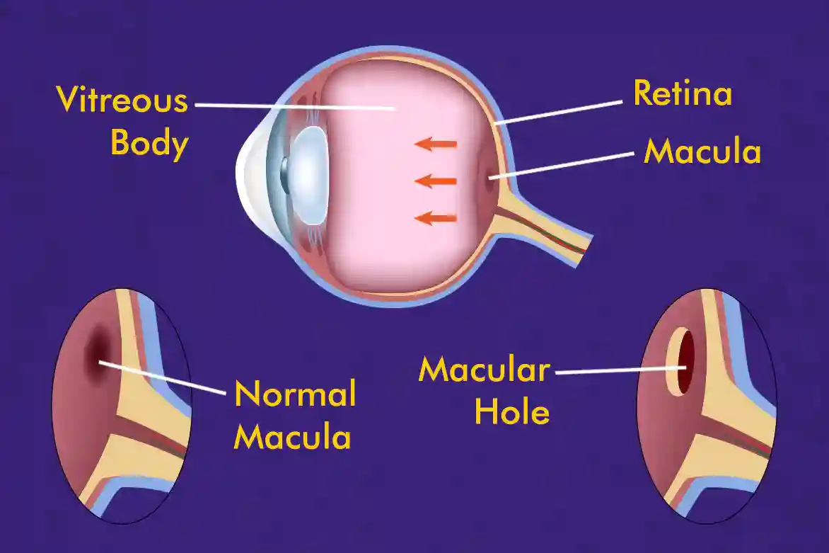 Macular Hole