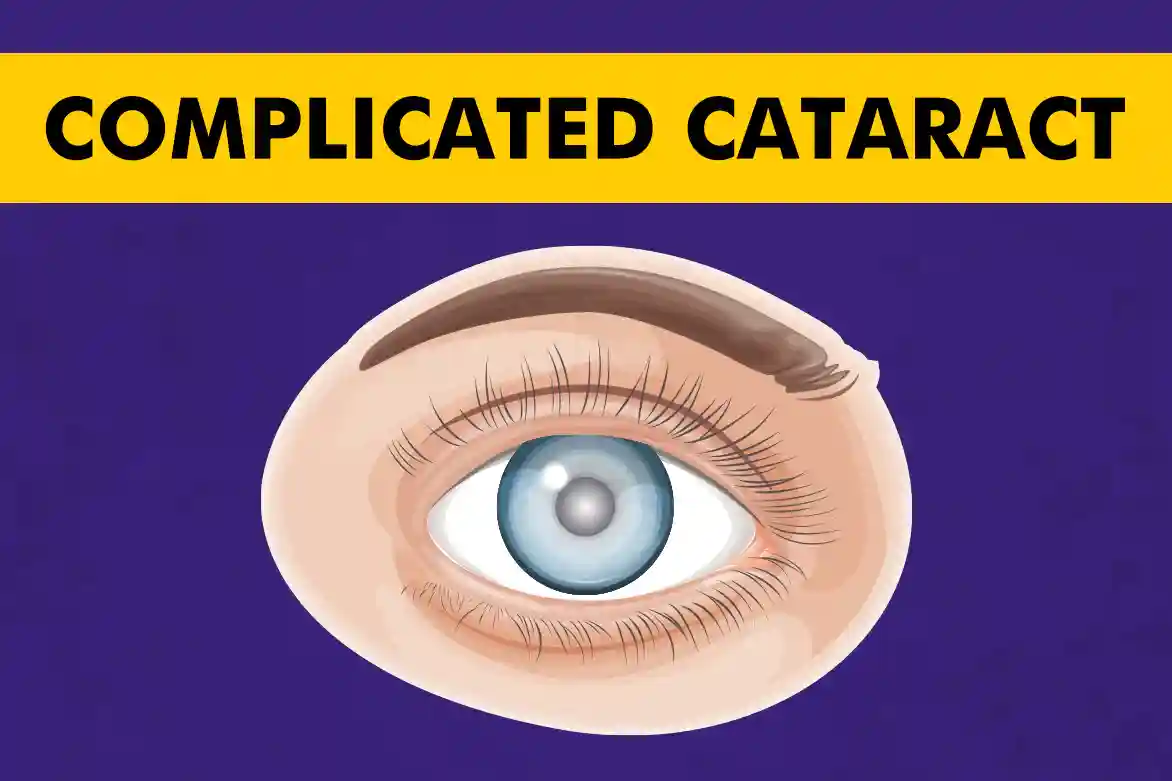 Complicated-Cataract