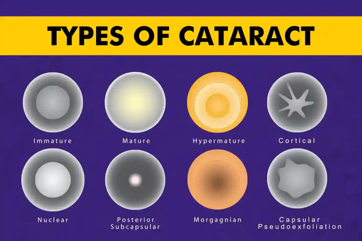 types of cataracts