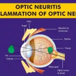 Optic neuritis