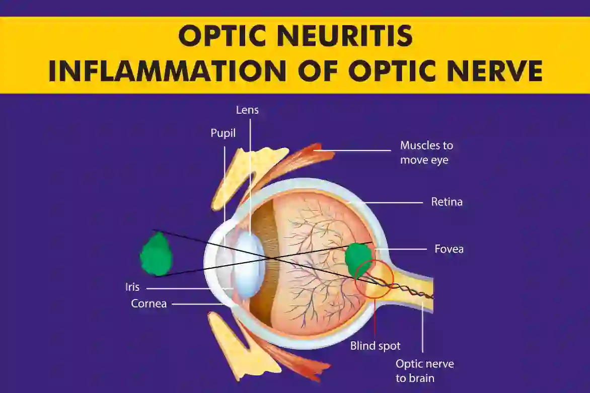 Optic neuritis