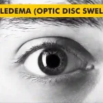 Papilledema-Optic Disc Swelling