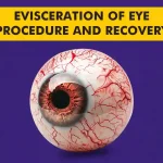 Evisceration procedure and recovery guide