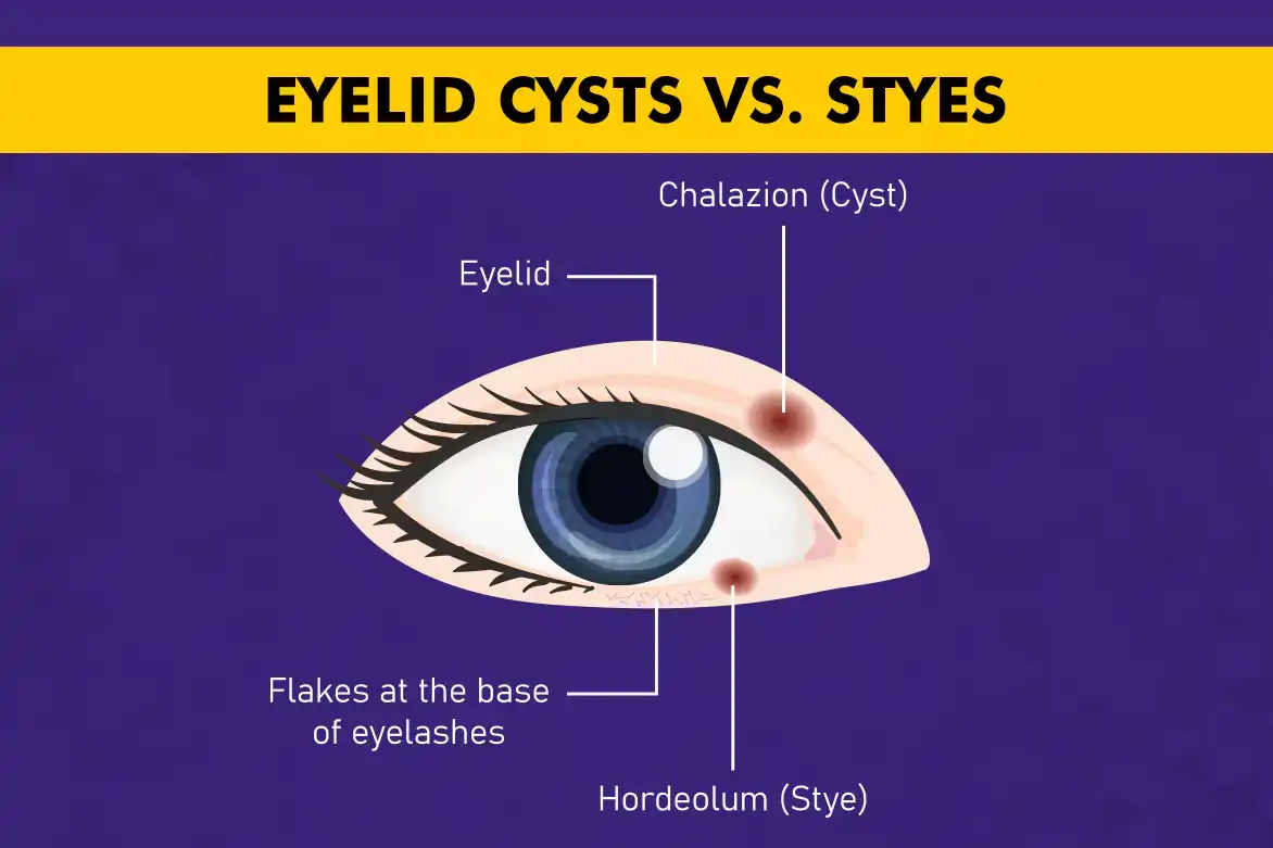 Eyelid-Cysts-vs.-Styes