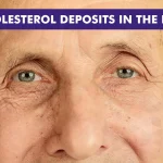 Cholesterol Deposits in Eyes