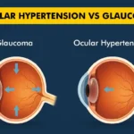 Ocular Hypertension vs Glaucoma Key Differences You Should Know