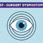 Post-Surgery Dysphotopsia Unwanted Visual Effects After Cataract Removal