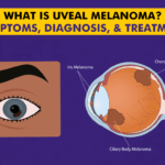 Uveal Melanoma